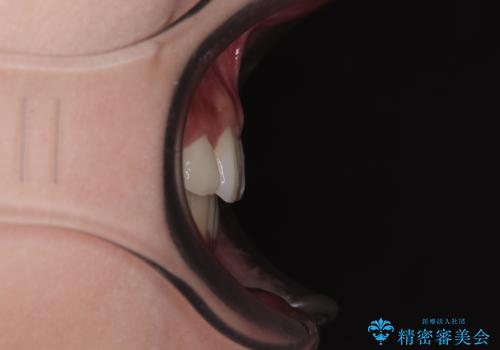 飛び出した前歯 インビザラインを用いた抜歯矯正治療の治療後