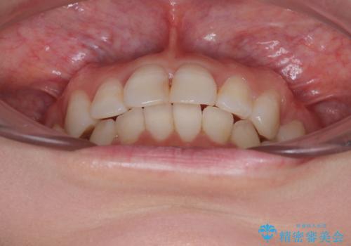 マウスピースが面倒くさい インビザラインでできるところまで頑張った矯正治療の治療後
