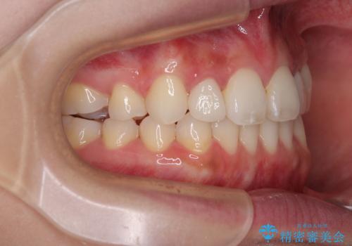 飛び出した前歯 インビザラインを用いた抜歯矯正治療の治療後