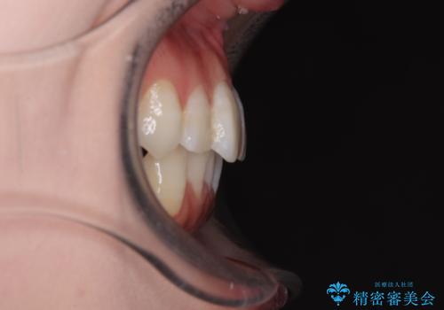 マウスピースが面倒くさい インビザラインでできるところまで頑張った矯正治療の治療後