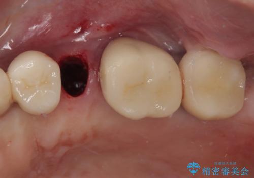 破折によりクラウンの外れてしまった奥歯 抜歯即時埋入で短期間インプラント治療の治療中