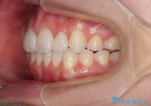 飛び出した前歯 インビザラインを用いた抜歯矯正治療の治療後