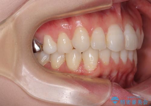 マウスピースが面倒くさい インビザラインでできるところまで頑張った矯正治療の治療後