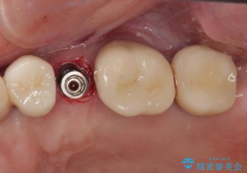 破折によりクラウンの外れてしまった奥歯 抜歯即時埋入で短期間インプラント治療の治療後