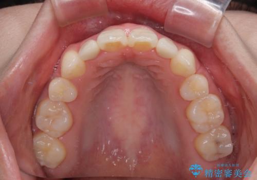 飛び出した前歯　インビザラインを用いた抜歯矯正治療の治療後