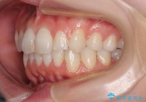 マウスピースが面倒くさい インビザラインでできるところまで頑張った矯正治療の治療後