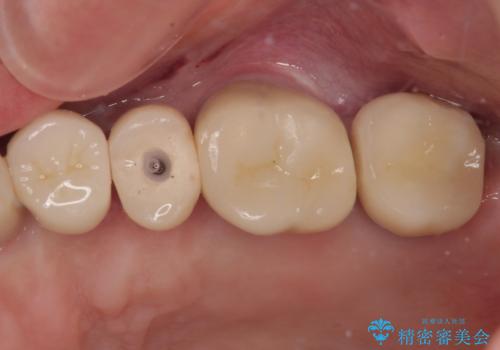 破折によりクラウンの外れてしまった奥歯 抜歯即時埋入で短期間インプラント治療の治療中