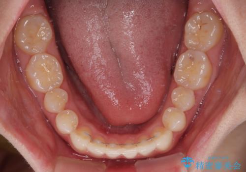 飛び出した前歯 インビザラインを用いた抜歯矯正治療の治療後