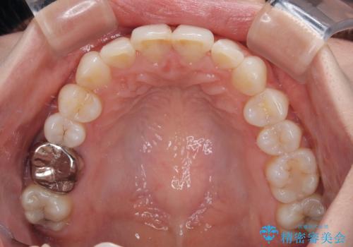 マウスピースが面倒くさい インビザラインでできるところまで頑張った矯正治療の治療後