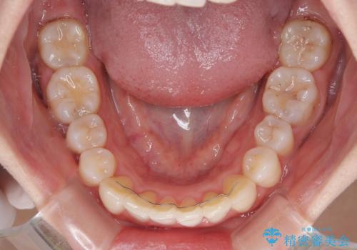 マウスピースが面倒くさい インビザラインでできるところまで頑張った矯正治療の治療後