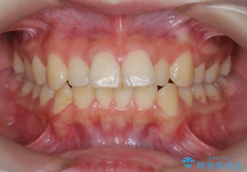 マウスピースで行う出っ歯の改善 後方移動の症例 治療前