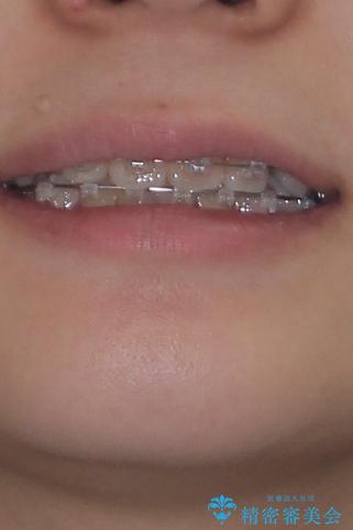 転勤でも安心して治療継続 抜歯スペース閉鎖と深い噛み合わせ改善のワイヤー矯正の治療前(顔貌)