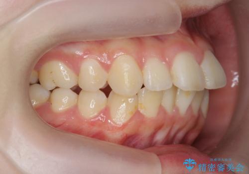 マウスピースで行う出っ歯の改善 後方移動の治療前