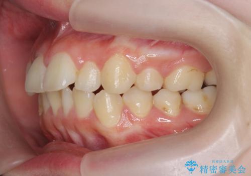 マウスピースで行う出っ歯の改善 後方移動の治療前