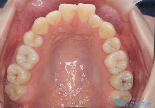 マウスピースで行う出っ歯の改善 後方移動の治療前
