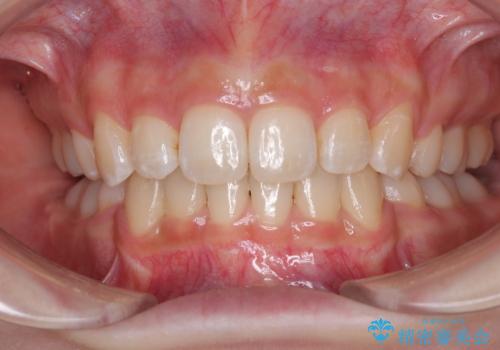 出っ歯を治したい ワイヤー装置での抜歯矯正の症例 治療後