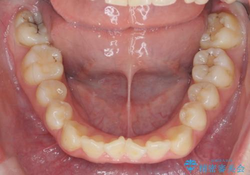 マウスピースで行う出っ歯の改善 後方移動の治療前