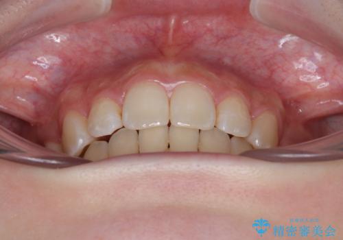 出っ歯を治したい ワイヤー装置での抜歯矯正の治療後