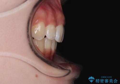 出っ歯を治したい ワイヤー装置での抜歯矯正の治療後