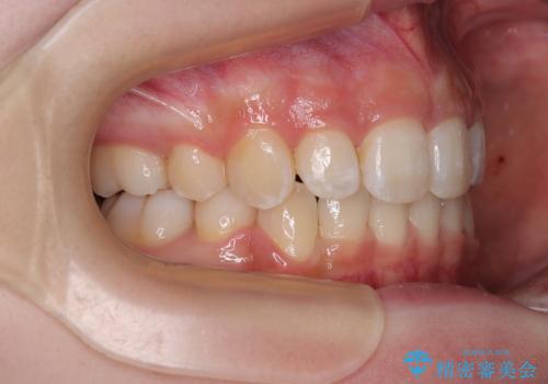 出っ歯を治したい ワイヤー装置での抜歯矯正の治療後