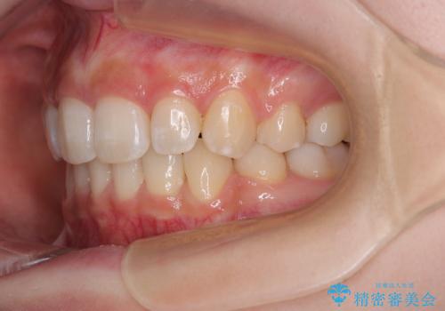 出っ歯を治したい ワイヤー装置での抜歯矯正の治療後