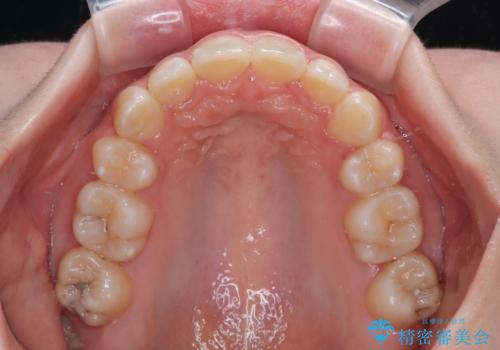 出っ歯を治したい ワイヤー装置での抜歯矯正の治療後