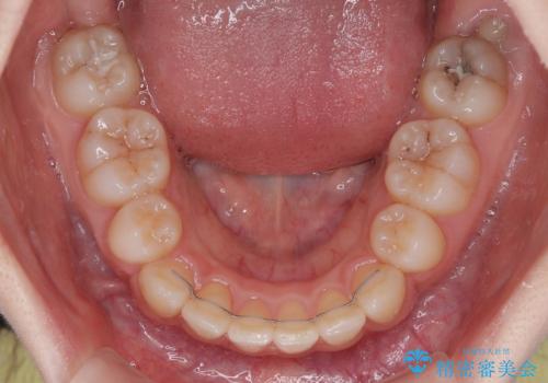 出っ歯を治したい ワイヤー装置での抜歯矯正の治療後