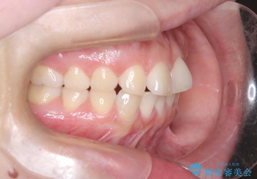 歯のデコボコを治したい! |インビザラインでわずか6ヵ月で矯正完了!の治療前