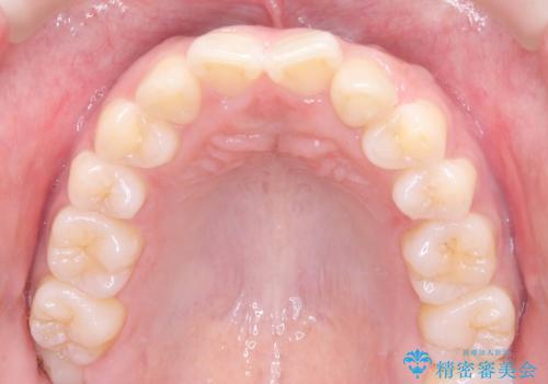 歯のデコボコを治したい! |インビザラインでわずか6ヵ月で矯正完了!の治療前