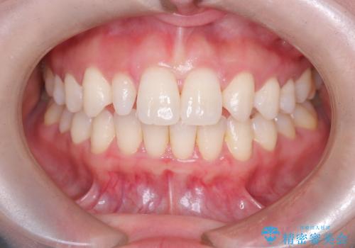 前歯の見た目が気になる!|矮小歯をオールセラミッククラウンで綺麗な形に!|審美回復の治療前