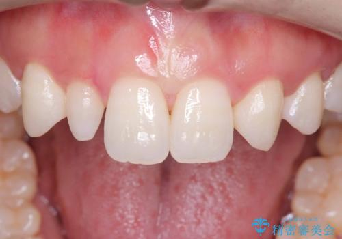 前歯の見た目が気になる!|矮小歯をオールセラミッククラウンで綺麗な形に!|審美回復の治療前