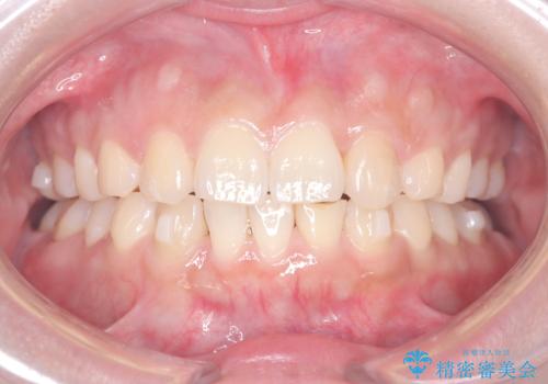 歯のデコボコを治したい! |インビザラインでわずか6ヵ月で矯正完了!の治療中