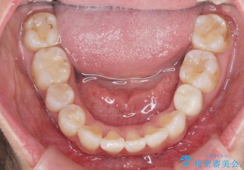 がたつきと出っ歯 ワイヤー矯正での歯並び改善の治療後
