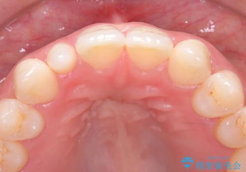 前歯の見た目が気になる!|矮小歯をオールセラミッククラウンで綺麗な形に!|審美回復の治療前