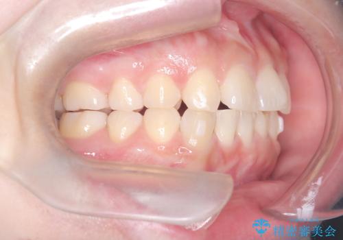 歯のデコボコを治したい! |インビザラインでわずか6ヵ月で矯正完了!の治療中