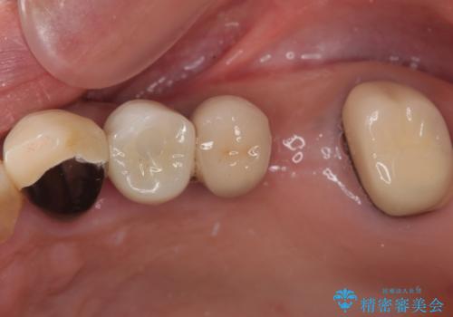 抜歯が必要な歯をインプラントに 短期間インプラント治療の症例 治療後