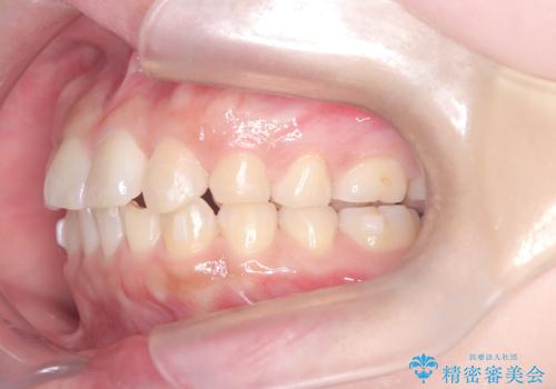 歯のデコボコを治したい! |インビザラインでわずか6ヵ月で矯正完了!の治療中