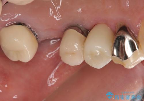 抜歯が必要な歯をインプラントに 短期間インプラント治療の治療後