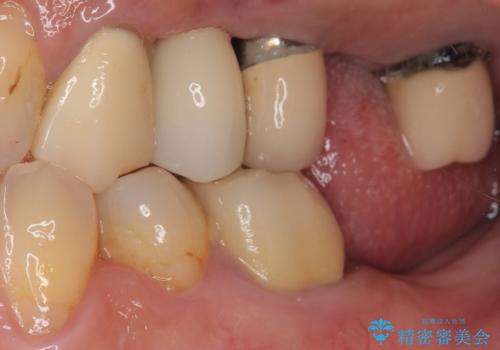 抜歯が必要な歯をインプラントに 短期間インプラント治療の治療後