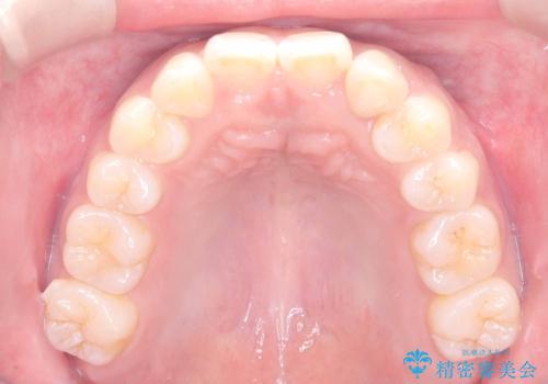 歯のデコボコを治したい! |インビザラインでわずか6ヵ月で矯正完了!の治療中