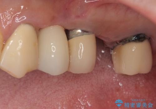 抜歯が必要な歯をインプラントに 短期間インプラント治療の治療後