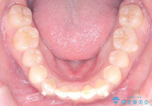 歯のデコボコを治したい! |インビザラインでわずか6ヵ月で矯正完了!の治療中