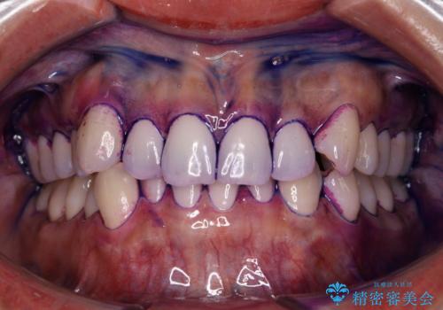 染め出しをしてエアフローで綺麗にクリーニングの治療前