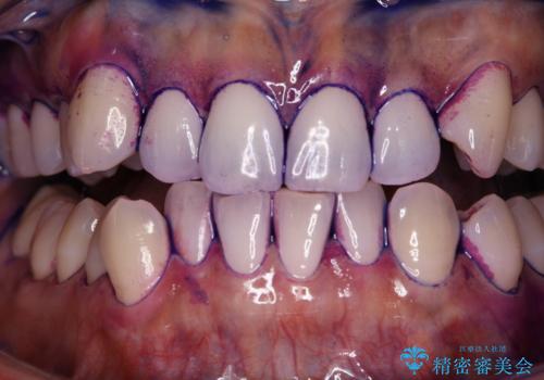 染め出しをしてエアフローで綺麗にクリーニングの治療前