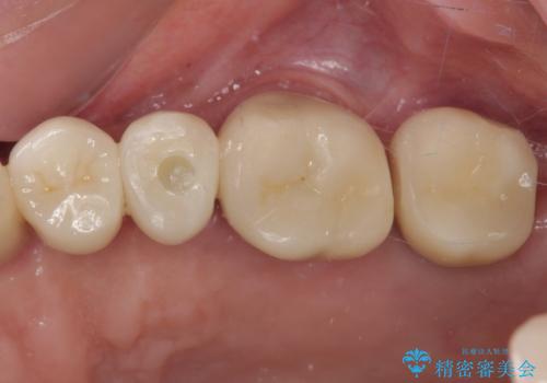 破折によりクラウンの外れてしまった奥歯 抜歯即時埋入で短期間インプラント治療の症例 治療後