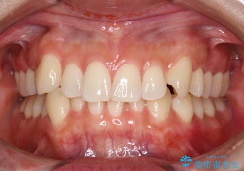 染め出しをしてエアフローで綺麗にクリーニングの治療後