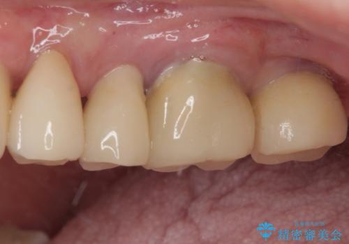 破折によりクラウンの外れてしまった奥歯 抜歯即時埋入で短期間インプラント治療の治療後