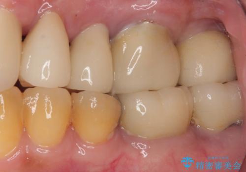 破折によりクラウンの外れてしまった奥歯 抜歯即時埋入で短期間インプラント治療の治療後