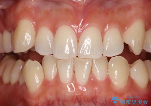 染め出しをしてエアフローで綺麗にクリーニングの治療後