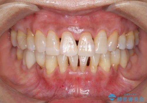 年齢と共に黄ばんだ口元を綺麗にの症例 治療後